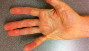 Hand image example of Dupuytren's Contracture requiring treatment.